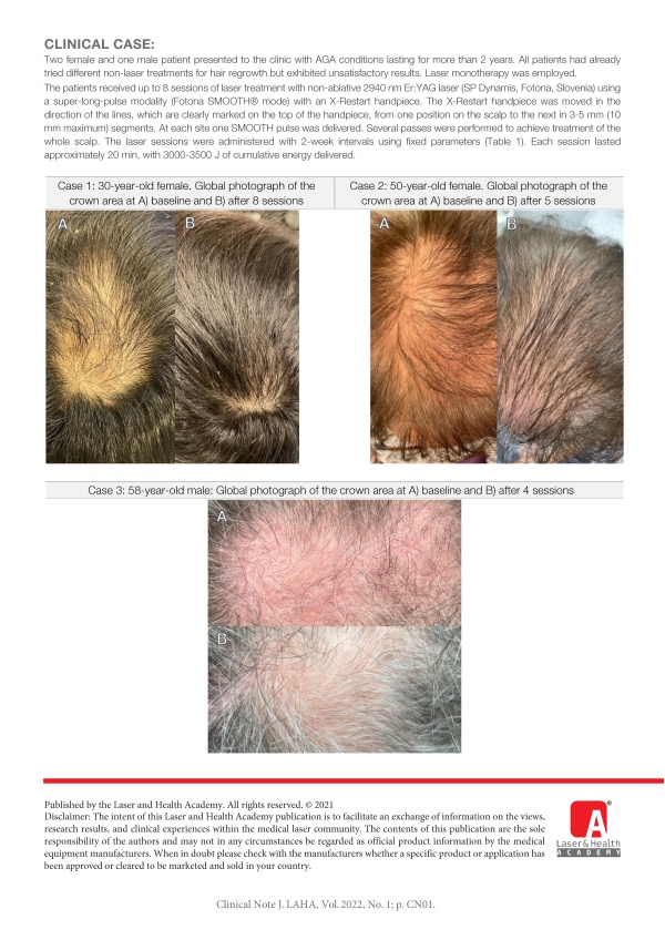 X-Restart Treatment of Androgenetic Alopecia