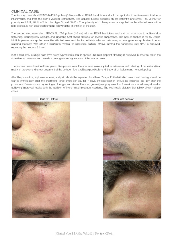 Treatment of Scars Combining Er:YAG and Nd:YAG using the SP Dynamis Laser