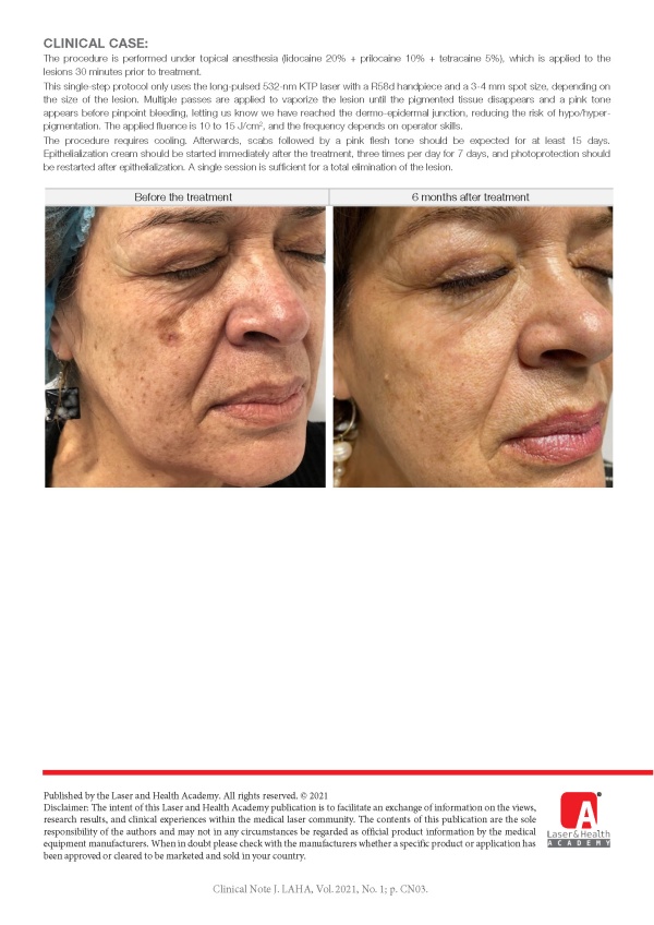 Laser Treatment of Seborrheic Keratosis with the StarWalker MaQX Long-Pulse KTP laser (VERDE)