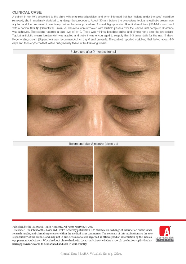 Xanthelasma Removal