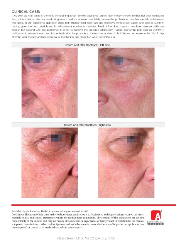 Facial Telangiectasias Treatment