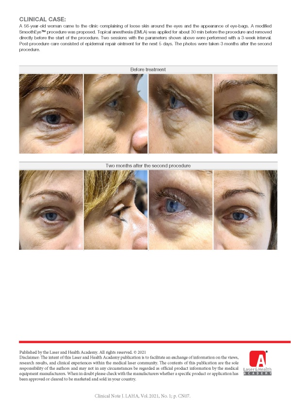 Modified SmoothEye™ Protocol