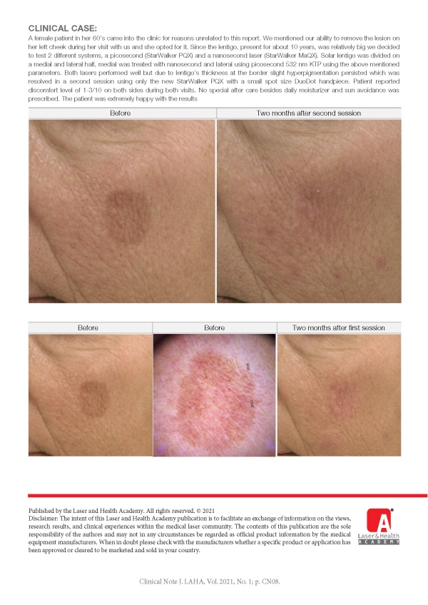 Picosecond Solar Lentigo Removal