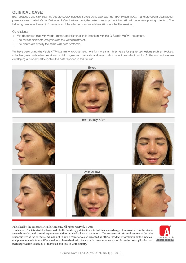 Split-Face, KTP-532 nm (MaQX vs Verde Pulse) Treatment of Freckles with Fotona’s StarWalker MaQX System