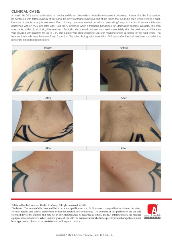 Tattoo Removal with Fractional Pre-Treatment