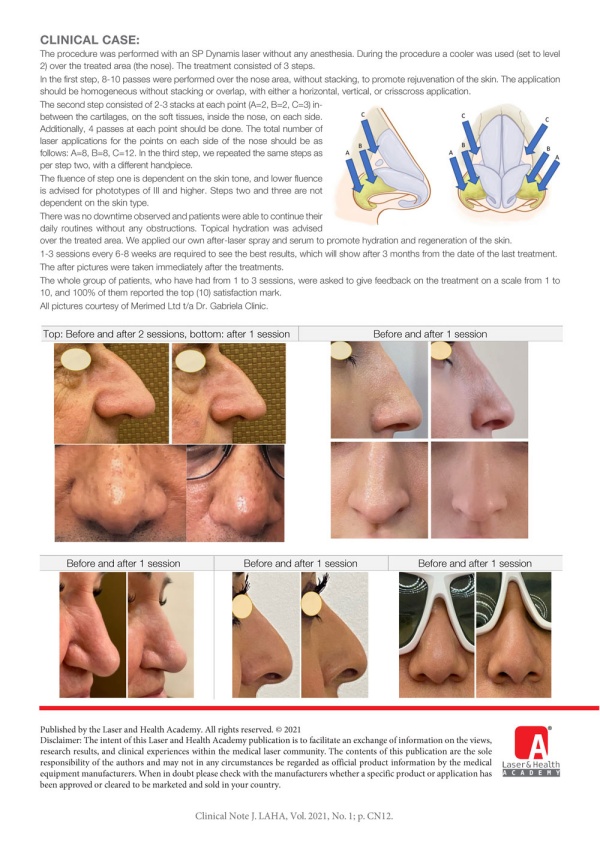 Multimodal Laser Treatment for Nasal Reshaping with Nd:YAG and Er:YAG Laser