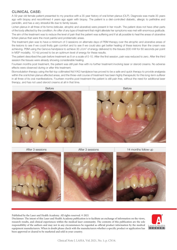 Treatment of Oral Lichen Planus with Photobiomodulation using 1064 nm Nd:YAG