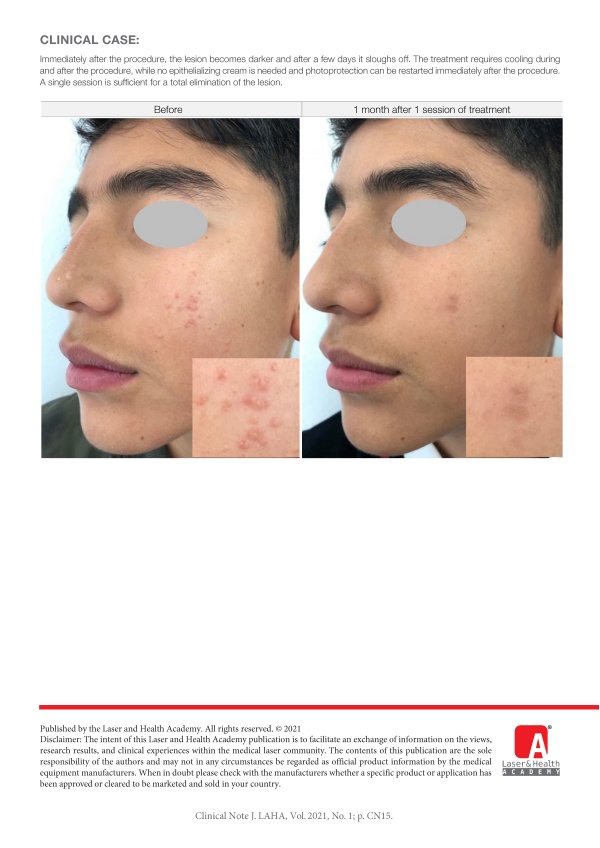 Laser Treatment for Flat Viral Warts with Nd:YAG Laser