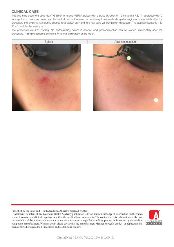 Treatment of Spider Angioma with Nd:YAG laser