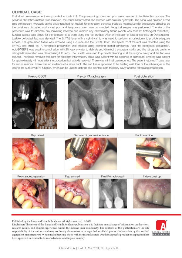 Periapical Surgery of Tooth #11 Suffering from a Chronic Periapical Abscess