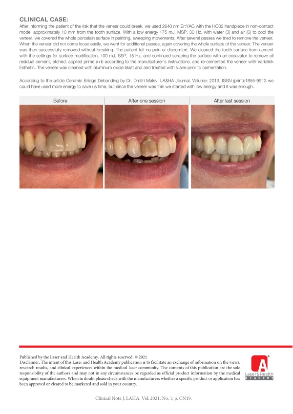 Veneer Removal