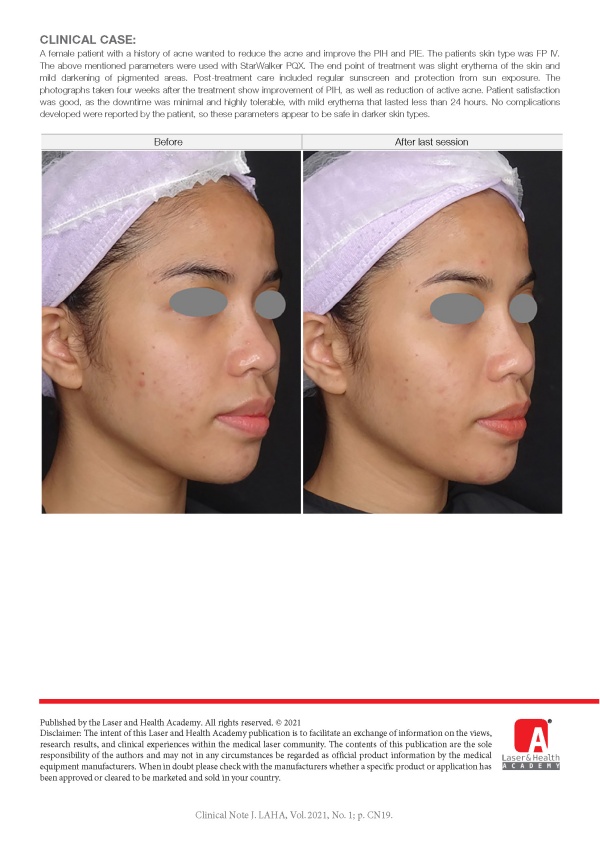 Acne & PIH Treatment with PQX Laser in Darker Asian Skin