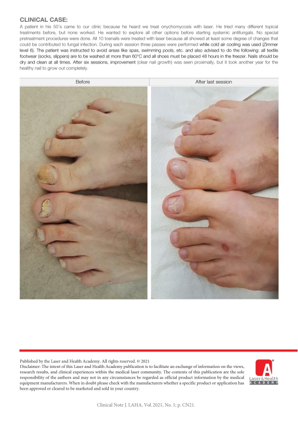 Successful Treatment of Resistant Onychomycosis