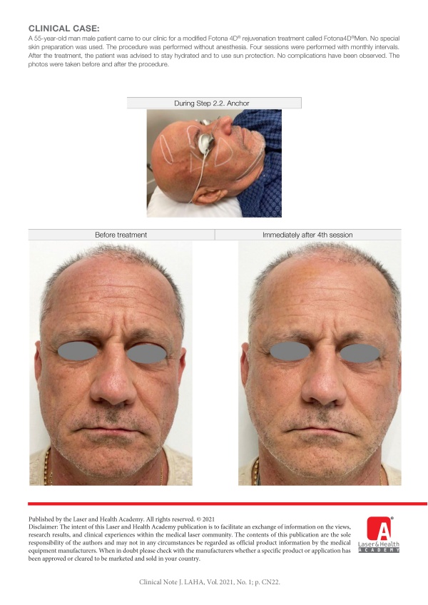 Fotona4D®Men - Rejuvenation for Men