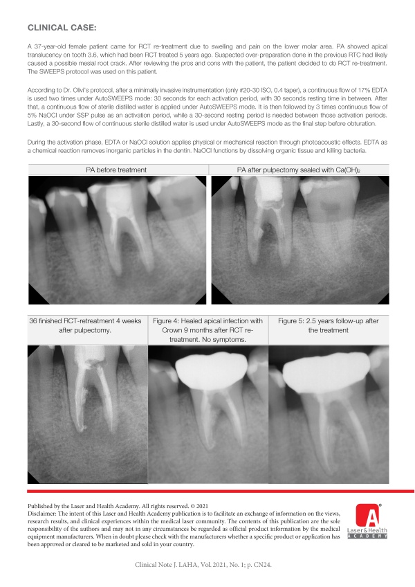 SWEEPS Protocol with Fotona LightWalker, a Game Changer for Root Canal Treatment