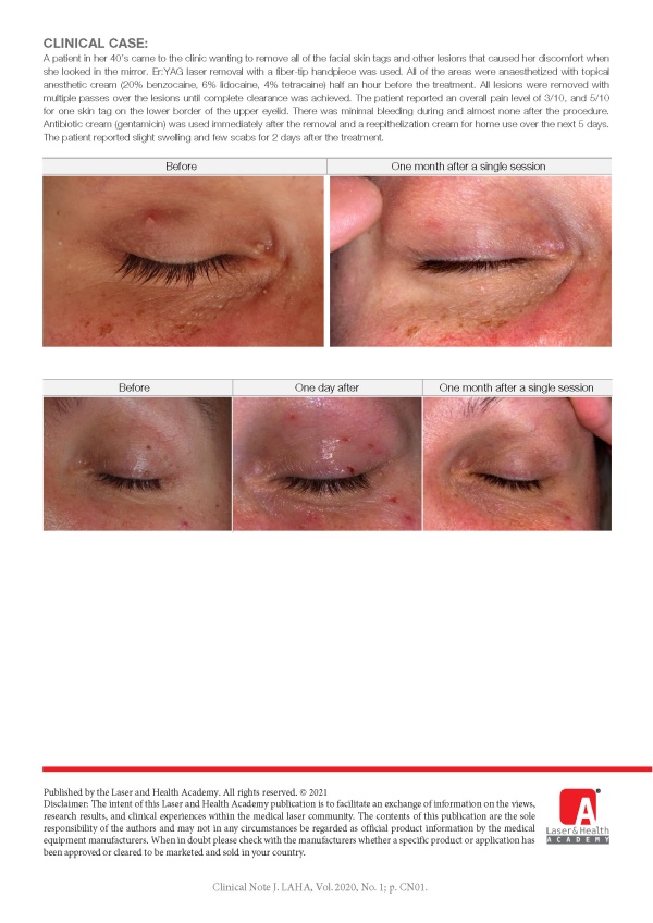 High Precision Ablation of Benign Skin Lesions