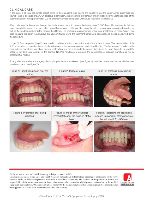 Treatment of Inflammatory Fibrous Hyperplasia (Epulis fissuratum) with Er:YAG Caused by Dental Prosthesis