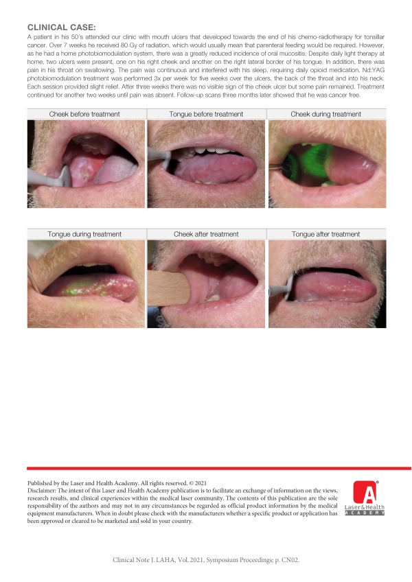 Nd:YAG Photobiomodulation for the Treatment of Oral Mucositis