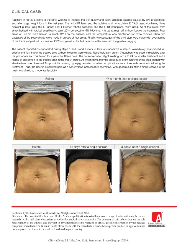 Highly Effective, 3-Step, Dual-Wavelength Multipulsed Laser to Combat Sagging Skin 