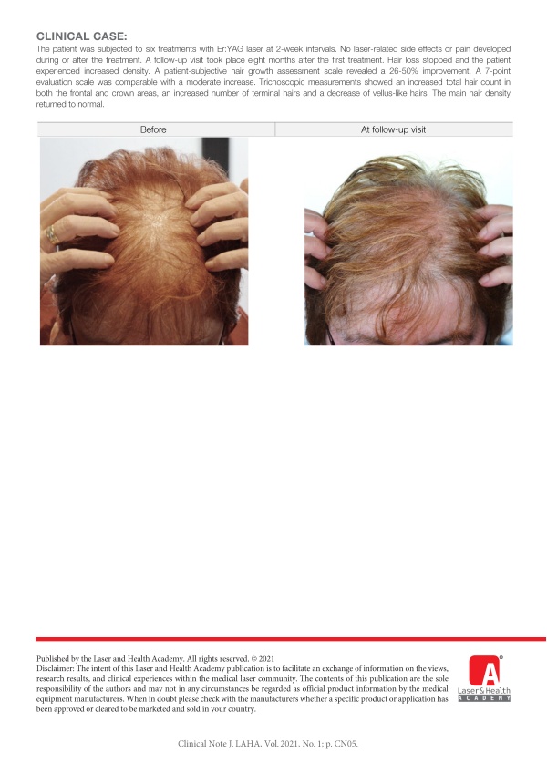 Non-ablative Er:YAG Laser Treatment of Female Pattern Hair Loss