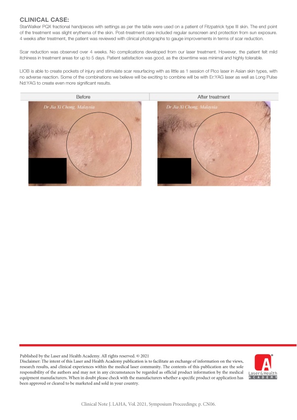 Acne Scar Treatment with Pico Laser in Asian Skin