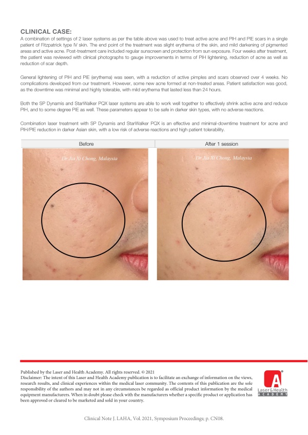 Benefits of Long Pulse Nd:YAG & Pico Laser Combination for Acneic Asian Skin