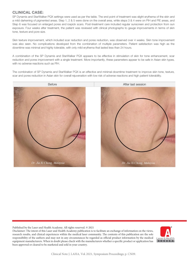 Combination of Long-Pulse Nd:YAG & Picosecond Laser for Skin Tone, Scar & Pore Reduction in Asian Skin