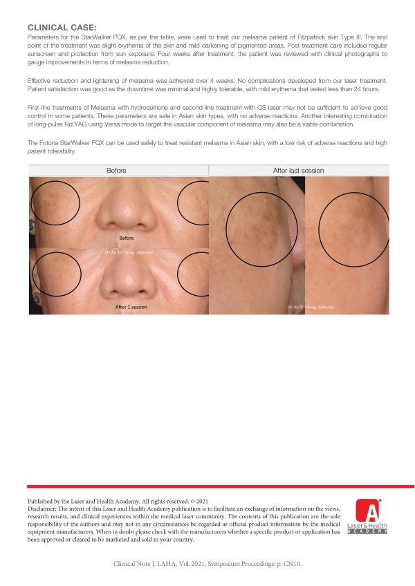 Melasma Management with Picosecond Laser in Asian Skin