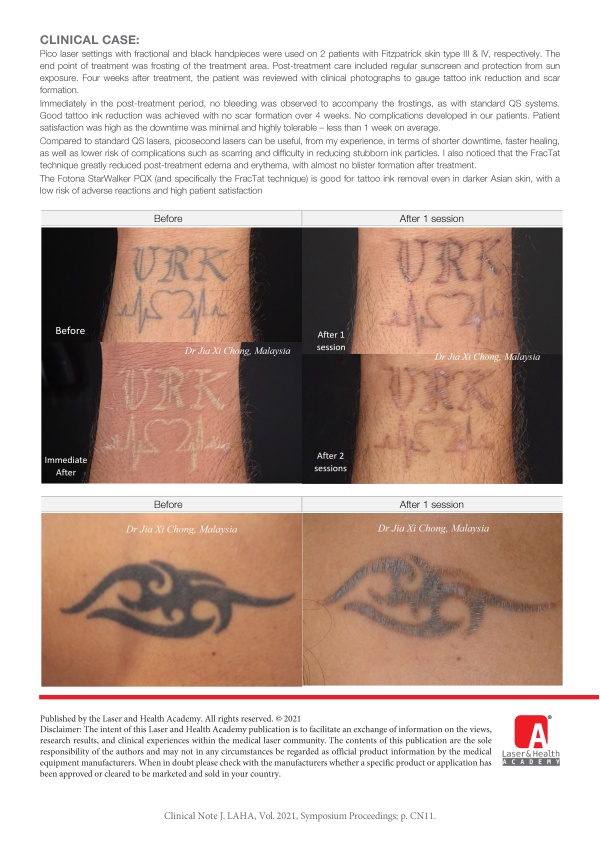 Pico Laser using FracTAT for Black Ink Tattoo Removal in Darker Asian Skin