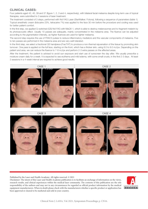 Treatment of Melasma with Multi-Pulse Nd:YAG Laser