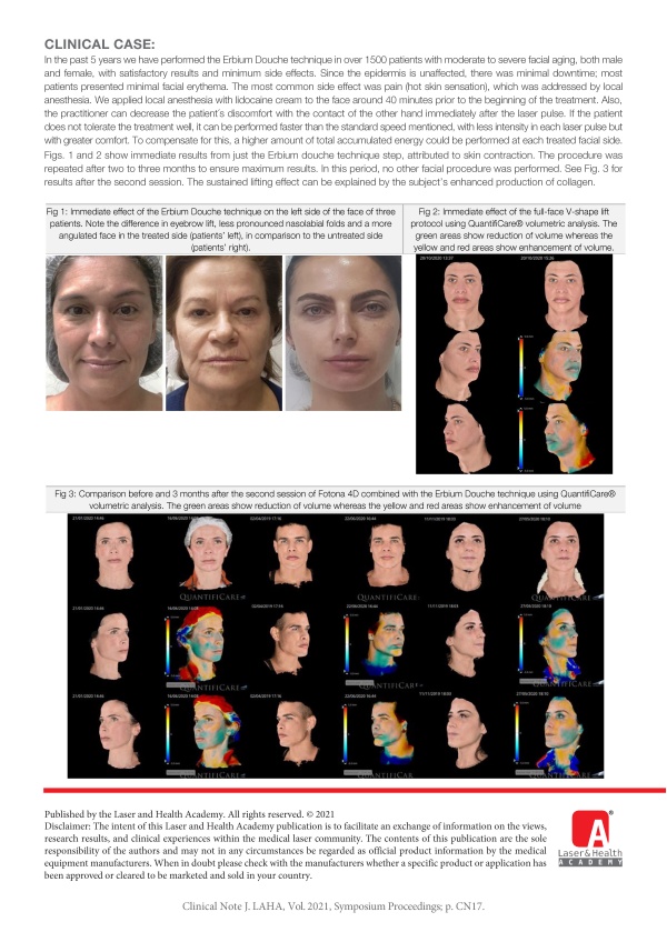 Fotona V-shape Facial Lift with Erbium Douche Technique