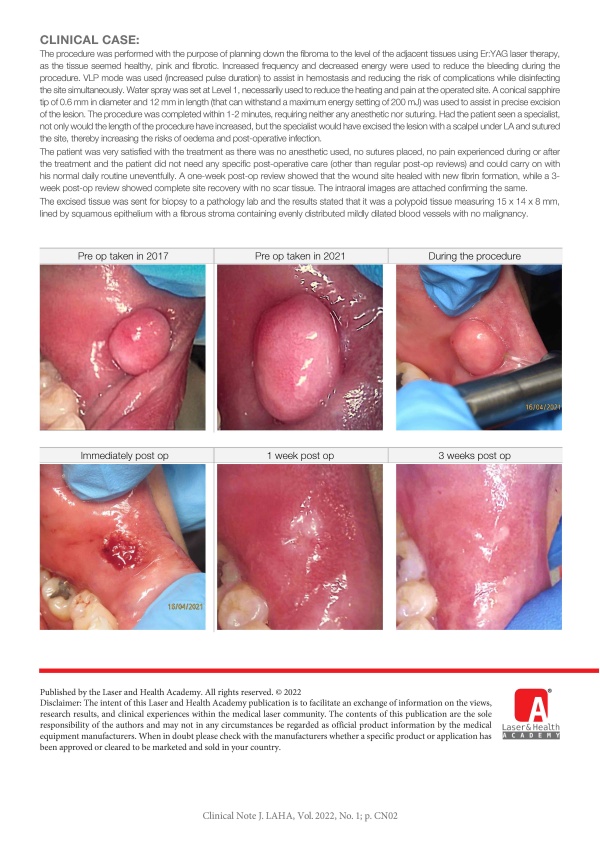 Oral Fibroma Removal Using Er:YAG Laser