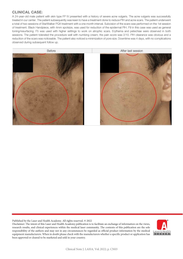 Management of PIH & Acne Scars in Asian Skin