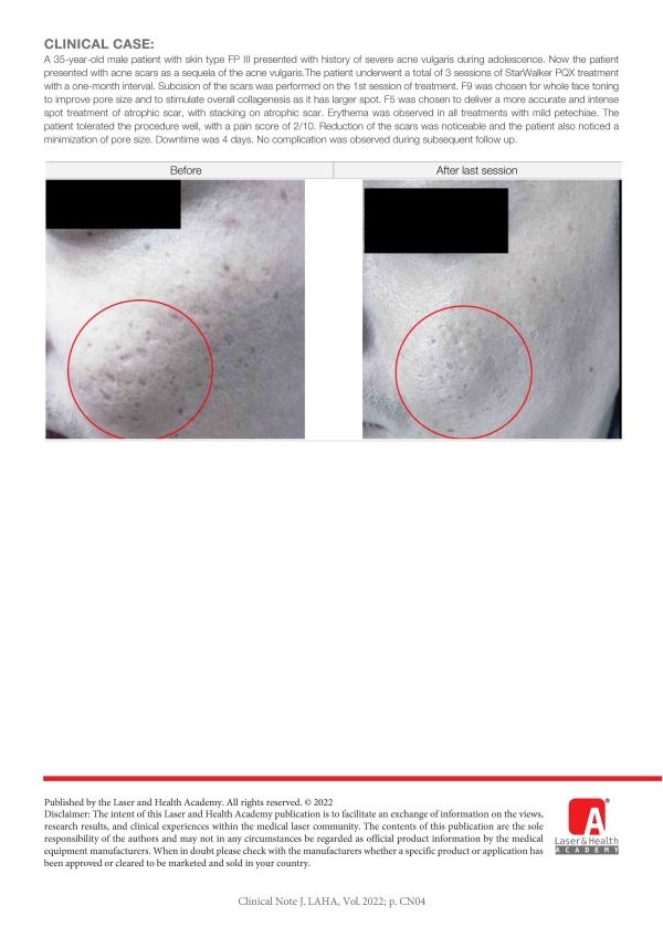 Management of Acne Scars in Asian Skin