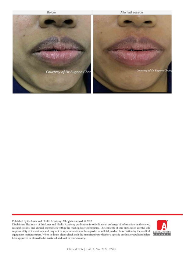 Management of Hyperpigmentation of Lips