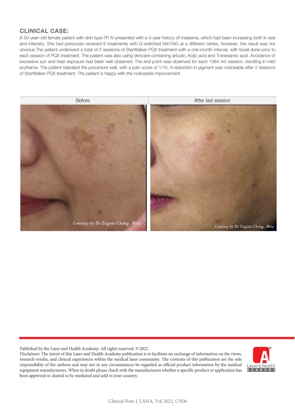 Treatment of Melasma in Asian Skin