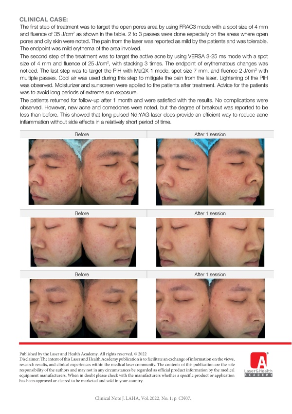 Multi-Modular Nd:YAG Laser as an Effective Acne Treatment
