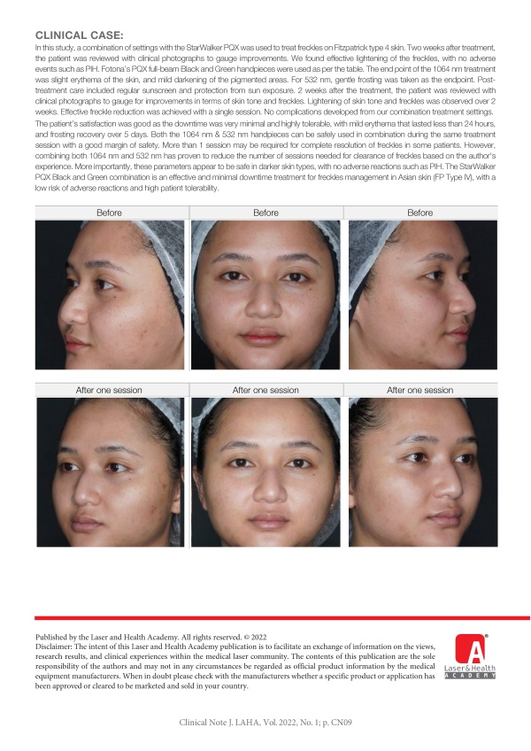Management of Asian Skin Freckles with Combination of 1064 nm & 532 nm Pico Laser
