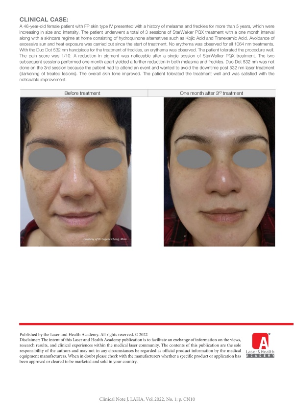 Management of Melasma in Asian Skin