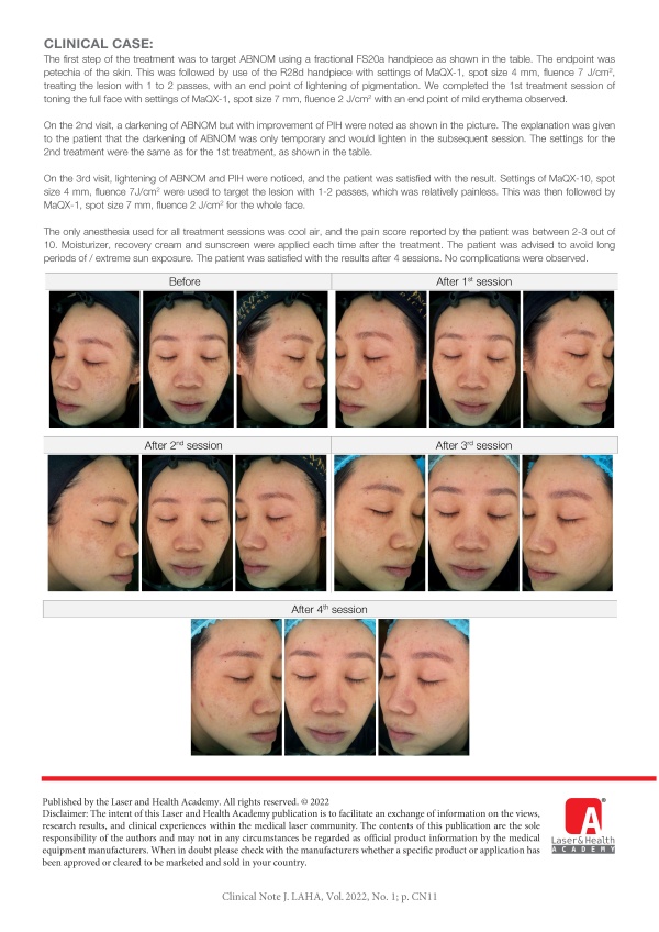 Multi-Pulse Nd:YAG Laser Treatment of Hori's Nevus