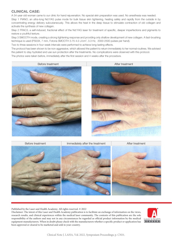 TwinLight Rejuvenation of the Hands