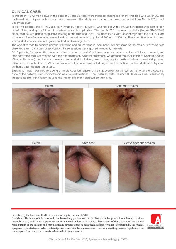 Lichen Sclerosus Treatment with Erbium:YAG Laser - Our Experience