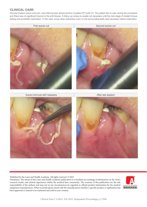 Laser Suture Removal - a New Application