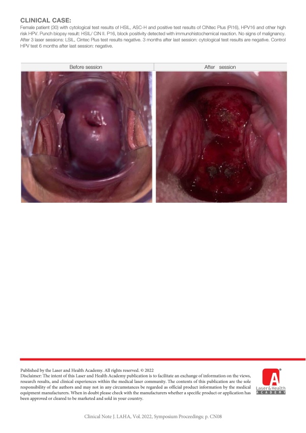 Laser Treatment of CIN and HPV Infection