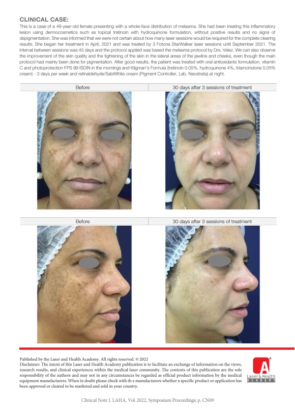 Melasma Treatment with 3 Sessions of Fotona StarWalker