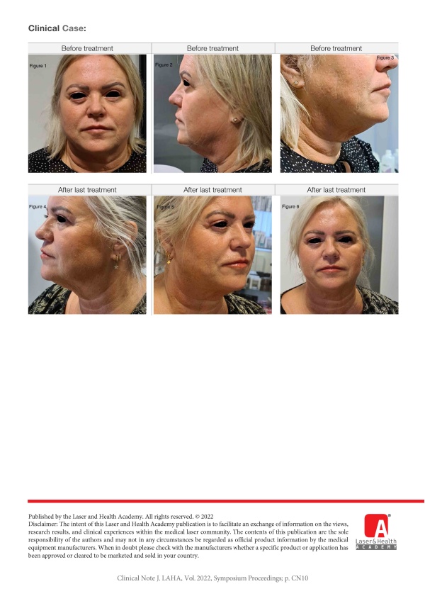 Combining Nd:YAG and Er:YAG Laser in Different Modalities for Skin Tightening