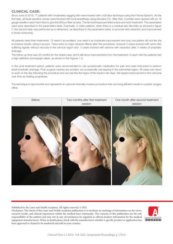 EndoTight approach for facial rejuvenation
