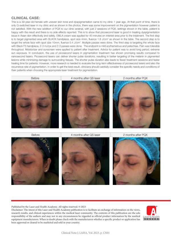 Review of effectiveness and safety of picosecond Nd:YAG laser compared to Q-switched laser for treatment of common pigmentary condition in Asian skin
