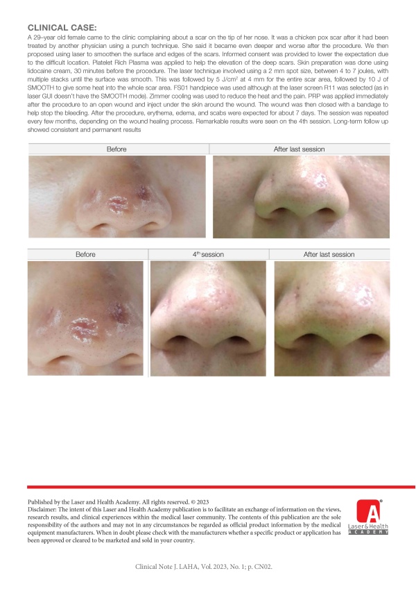 Combination Treatment of Nasal Scar using  2940 nm Er:YAG Laser and Platelet Rich Plasma