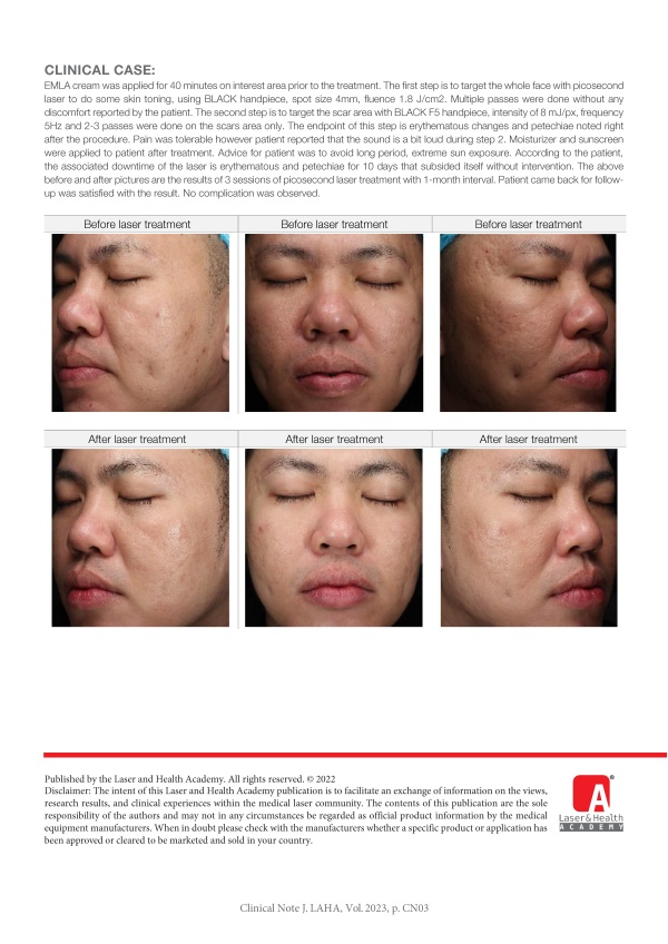 Effective Atrophic Scars Treatment with Picosecond Nd:YAG laser